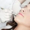 Microdermabrasion